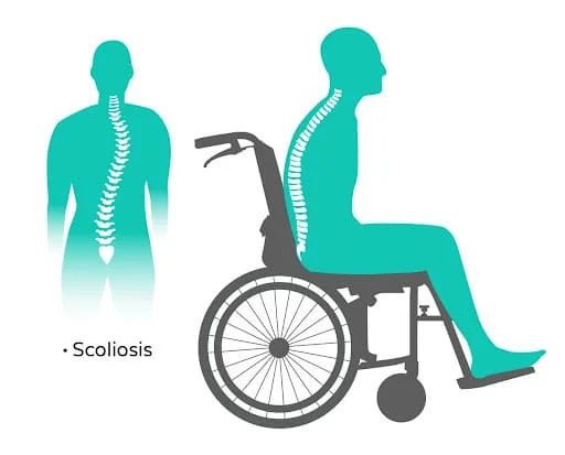 scoliosis