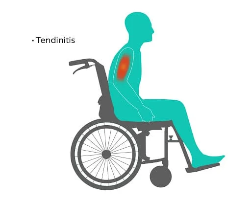 tendinitis