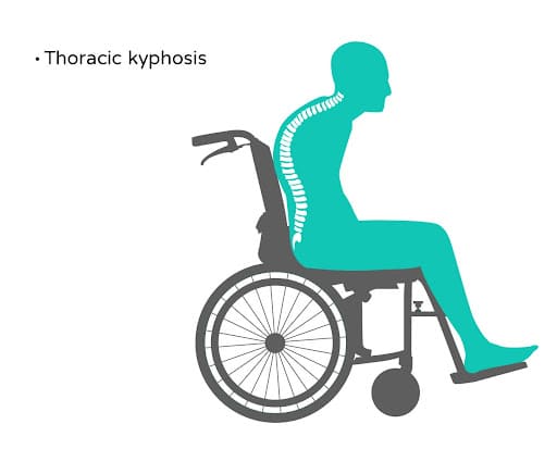 thoracic kyphosis